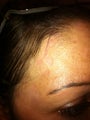 Scar Removal