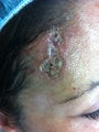 Scar Removal