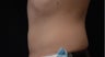 Coolsculpting