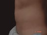 Coolsculpting