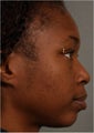 31 year old african american female with weak chin