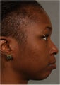 31 year old african american female with weak chin