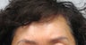 Brow Lift