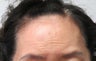 Brow Lift