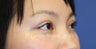Double Eyelid Asian Blepharoplasty