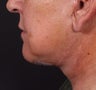 Female neck lift