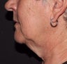 Female neck lift