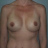 Breast Augmentation
