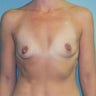 Breast Augmentation