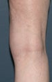 Before & After Leg Vein Treatment in San Diego 