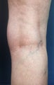 Before & After Leg Vein Treatment in San Diego 