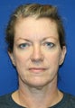 Facial Rejuvenation
