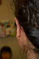 Otoplasty