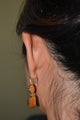Otoplasty