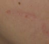 Traumatic Facial Scar after 6 Treatments with the 1540 Lux Fractional Laser