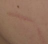 Traumatic Facial Scar after 6 Treatments with the 1540 Lux Fractional Laser