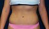 Tummy Tuck