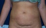 Tummy Tuck