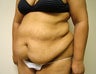 Abdominoplasty