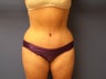 Tummy Tuck