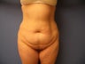 Tummy Tuck