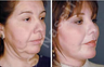 Complete Facial Rejuvenation