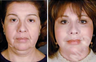 Complete Facial Rejuvenation