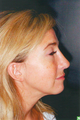 Revision Rhinoplasty