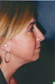 Revision Rhinoplasty