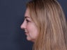 Nose Surgery