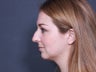 Nose Surgery