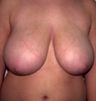 Breast Reduction