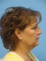 Facelift