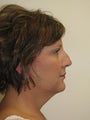 Facelift