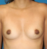 Breast Augmentation