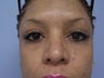 Rhinoplasty
