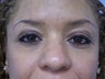 Rhinoplasty