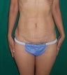 ultrashape