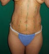 ultrashape