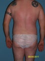 33 Year Old Male Desiring Liposuction 