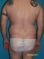 33 Year Old Male Desiring Liposuction 