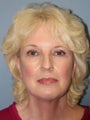 Neck Lift on 60-year-old