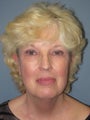 Neck Lift on 60-year-old
