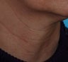 Fraxel Repair
