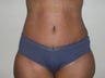 Tummy Tuck