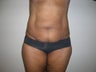 Tummy Tuck