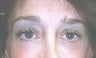 Female patient who underwent a brow lift 