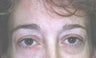 Female patient who underwent a brow lift 