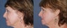 Laser Skin Resurfacing