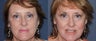 Laser Skin Resurfacing